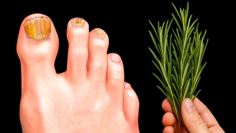 Kein Arzt wird dir das sagen… Ein Hausmittel lässt Pilz über Nacht verschwinden!